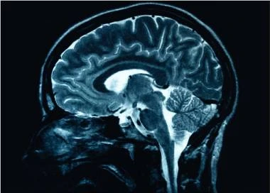 Leziunile cerebrale cauzate de Alzheimer ar putea fi reversibile, în urma unei noi descoperiri genetice